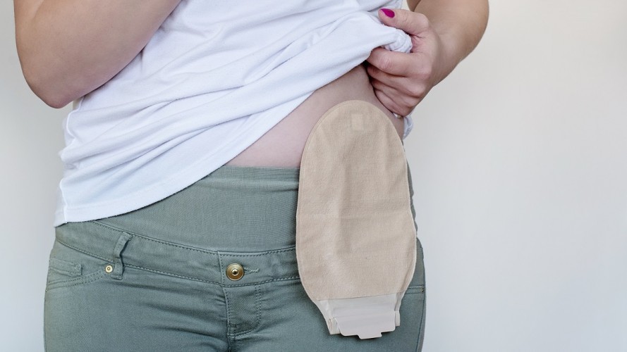 Sorriso: vereadora pede ampliação da oferta e melhoria na distribuição de bolsas coletoras para pacientes ostomizados